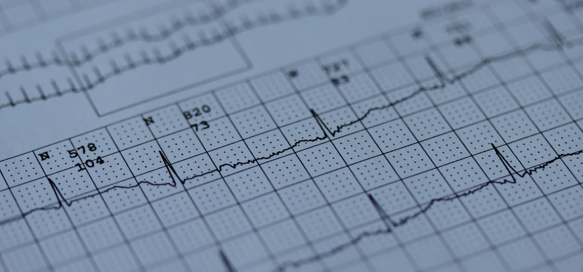 Close-up of an ECG printout on grid paper