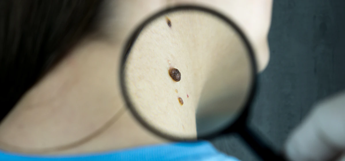 Magnifying glass examining moles on a patient’s skin